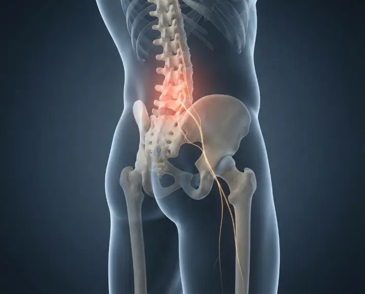 Illustration of the lumbar spine and pelvis with the lower back highlighted