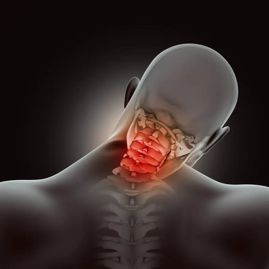 Illustration of the cervical spine with the neck highlighted in red to show whiplash-related pain