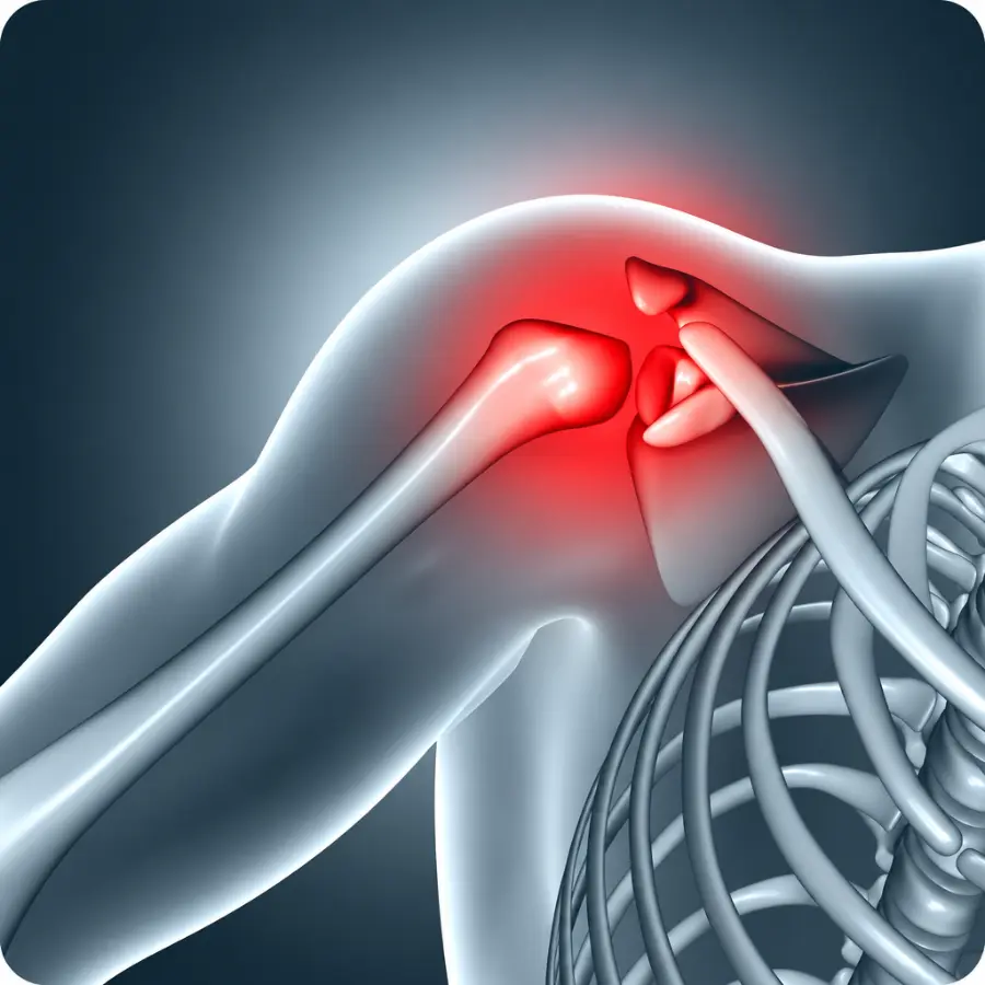 Illustration of a shoulder joint highlighted in red to show shoulder pain